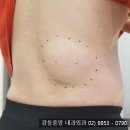 천보성 | 등지방종제거 병원 선택시 고려해야할 사항?(천보성 외과)