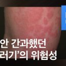 [5분 건강 톡톡] 부푸는 ‘두드러기’… 6주 이상 지속되면 ‘경고’ / KBS뉴스(News) 이미지