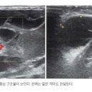 림프관 (Lymphangioma) 이미지
