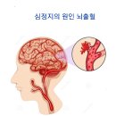 영화배우 강수연을 무너뜨린 ‘뇌출혈', '심정지의 원인' 뇌출혈은 왜 오는가 ? 이미지