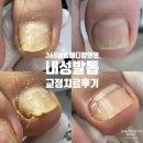 늘봄의원 | [내성발톱 2회교정] 365늘봄메디칼의원 내성발톱교정후기 군포 의왕역 안양 안양역 부곡동 교정치료전문...
