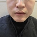 맑은샘이비인후과의원 | 누가이비인후과 비염수술1일차 후기(하비갑개 절제술)