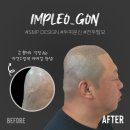 임플레오 | 성수동 헤어라인 타투 브랜드 임플레오 흉터 깔끔하게 지워드립니다!