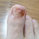새부광약국 | [공지] 발톱무좀 쑥뜸 치료후기 (완치 성공)