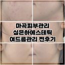 심은하에스테틱 여드름관리 4회차 후기!(비포/애프터이씀!)