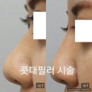 조에피부과 네이버블로그