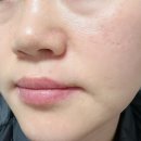 간석비타민약국 | 인천 구월동 피부관리 엘레나이젠 엑소마지TF 스킨부스터 찐 후기!