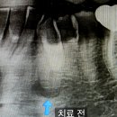 뿌리깊은치과의원 | 잇몸뼈 녹음 재생? 치아 뿌리 염증 심각해서 잇몸뼈...신경치료로 잇몸뼈 재생 후기! [마포 신경치료 치과]