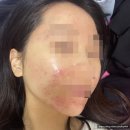 윤앤송한의원 | 서울 강남 윤앤송한의원 여드름치료(피지침+미세침) 5-9회차 후기