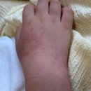 기생한의원 | 대구두드러기 한의원으로 극복하는법