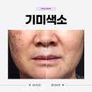 원효초교 | 용산피부과, 출산 후 피부가 예전 같지 않아서 받은 기미치료 후기