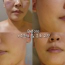 본피부 에스테틱 분당야탑점 | 분당 야탑에스테틱 물방울 초음파 로 촉촉해진 피부완성 본피부에스테틱분당야탑점