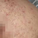 상계역한의원 롤링성 흉터 새살침 후기