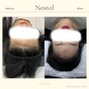명도헤어라인 네이버블로그