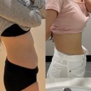 안*제 | 압구정피부과 온다리프팅 + 지방분해주사 내돈내산 후기