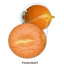 망막전막증 및 (황반주름, 유리체절제술) 이미지