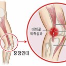 달릴 때 무릎 바깥쪽이 아프다면? &#39;장경인대증후군&#39; 의심 이미지