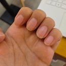 이손화장품 | 유방암 항암 후 손톱 언제 회복될까? 3차 항암 10일째부터 약해진 손톱 , 2년 후 현재와 손톱영양제 후기
