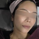 해율한의원 | 홍대 모공성흉터 약초침 해율한의원 홍대점 후기