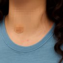 한걸음요양병원 | 갑상선 절제수술 이라니 병원ep 3 / 갑상선포럼카페