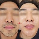스위스 익스필 | 제모의 새로운 기준｜피부를 살리는 PRO10솔루션! 스위스익스필