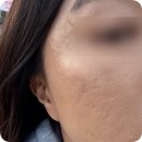 명동한의원 여드름흉터 새살침 2회차 후기 및 비포애프터