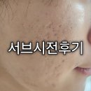 내돈내산, 여드름 흉터 서브시전 + 쥬베룩 후기