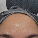 대지한의원 | 천안여드름흉터한의원 9회차 내돈내산 솔직후기