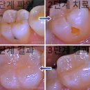 상아치과재료 네이버블로그
