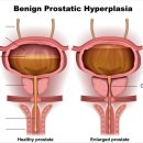 양성 전립선 비대증 (서울대학교병원) 이미지