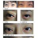 앞트임+흉터+눈매교정술 3번째 쌍꺼풀재수술입니다. 이미지
