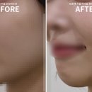 [대구성형외과] 보조개 수술 일주일 후기 (연세미사랑의원)