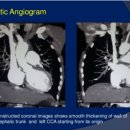 타카야수 혈관염(Takayasu's Arteritis)의 원인과 치료 방법 ​ 이미지