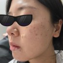 퇴근 길에 점/비립종/편사 제거하기 (제거일~2주 동안 술먹고 캠핑 다녀온 후기) - 성수 세린의원