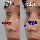 치유성형외과의원 | 남자코수술, 직선코라인 디자인이 핵심 – 강남성형외과