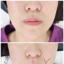 평촌 피부관리 재방문 시소에스테틱 리프팅 올티맥스 후기