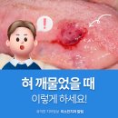 미소진약국 | 혀 씹었을 때 깨물었을 때 대처 방법 3가지