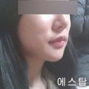 에스탑성형피부 네이버블로그
