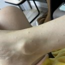 갑작스러운 두드러기(?) 알러지??? 직접 겪은 후기