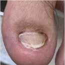 안양발톱무좀 병원 방문 없이 깔끔하게 관리받았어요 미엘네일 동성제약 풀리메디 범계점