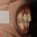 클리어치과교정과치과의원 | 수원 인계동 돌출입 치아교정 치과, 발치 없이 치료 마친 케이스 <공개>