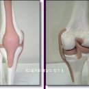 사상체질 - 다양한 무릎관절통의 원인 이미지