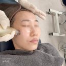 비고르바른건강+고주파 | 강남역피부과 피코토닝 비올 실펌엑스! 속기미 관리 효과 솔직후기