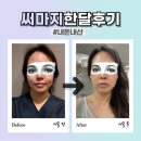 리주 네일 | 내돈내산 써마지+쥬베룩 병원추천 솔직후기 한달 붓기 효과 가격