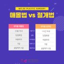 이명철성형외과의원 | 전주쌍꺼풀수술 후기가 GOOD!