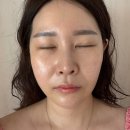 라임 | 강남피부과 울쎄라피프라임 후기 가격 300샷 한달차