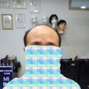 실제 고객의 헤어 변화 – 가발 착용 전후