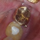 Blue 치과기공소 | 신경치료하고 씌웠는데 아파요 ㅠㅠ 교합이 안맞아요 - 서울덴치과는 교합치료 안하는데여?