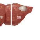 단순 피로로 착각하기 쉬운 지방간 초기증상 이미지