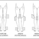 내반슬, 외반슬에 대한 고관절의 변화 이미지